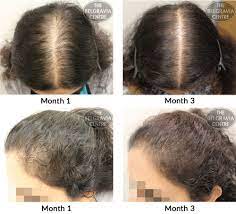 On the days when hair is washed, people can lose up to 250 strands,. Hair Growth Success Have Seen A Lot Of Improvement In Hair Growth