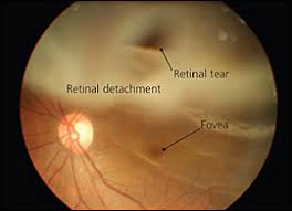 Surgery is almost always used to repair a retinal tear, hole or detachment. Ocular Emergencies American Family Physician