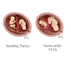 Twin To Twin Transfusion Syndrome Ttts Stages Diagnosis