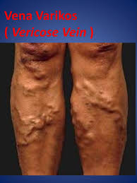 Generalmente aparecen en las piernas, pero pueden. Vena Varikos Vericose Vein Wannura Terapi
