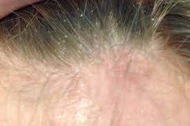 Image result for Seborrheic Dermatitis