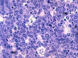 A review of the epidemiological evidence. Non Hodgkin S Lymphoma Lecturio Online Medical Library