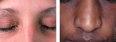 Image result for ekzema face