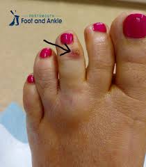 Pin On Northeast Foot Ankle Blogs