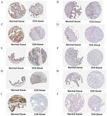 Coronavirus 2 du syndrome respiratoire aigu sévère cet article concerne un coronavirus. Upregulation Of Mir 132 3p In Cholangiocarcinoma Tissues A Study Based On Rt Qpcr The Cancer Genome Atlas Mirna Sequencing Gene Expression Omnibus Microarray Data And Bioinformatics Analyses