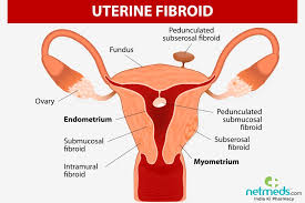 If it is located closer to. Uterine Fibroids Causes Symptoms And Treatment