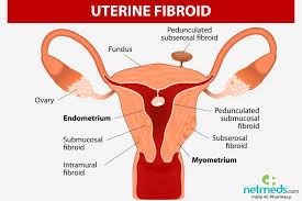 Symptoms of uterine cancer that are different from uterine fibroids include abnormal vaginal bleeding (bleeding that is not part of a menstrual period, bleeding after menopause), or a mass in the vagina. Uterine Fibroids Causes Symptoms And Treatment
