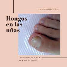 Hongos uña dedo gordo pie remedios caseros. Clinica Del Pie MÂª Sol Pastor Valle Tienes Alguna Mancha Extrana En Las Unas Una Manana De Sabado Mientras Te Cortas Las Unas Ves Que El Dedo Gordo Del Pie