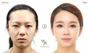 South Korea Plastic Surgery Eye Health Pictures Of Surgery Pictures Information Before After Eye Health Health Pictures Plastic Surgery