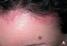 Image result for dermatitis contacta allergica