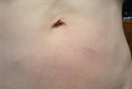 Also a new procedure, the torax is approved. Post Pic Of Your Scars Post Operation Weight Loss Surgery Q A Bariatricpal