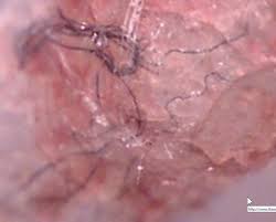 Sophia smallstorm at the consciousness beyond chemtrails conference, 2012. Morgellons Als Infektion Mit Pflanzenbakterium Dr Retzek S Umfassend Gesund