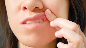 In smokers, these bumps appear as whitish color bumps on roof of mouth. Mouth Sores Pictures Causes Types Symptoms And Treatments