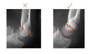 Image result for Elbow XRay