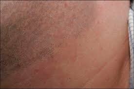 No longer is a simple laser, or ipl used to treat stubborn hair conditions. Laser Hair Removal Melbourne
