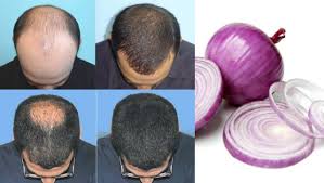 Onion juice for hair loss treatment: Get Rid Of Hair Loss Using Onion Juice Must Watch Onion Juice Hair Loss Solutions Hair Loss