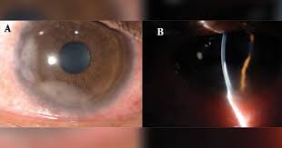 Image result for lesion sclera