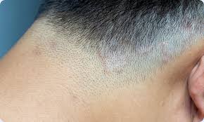 30 giovani uomini su 100 soffrono di perdita di capelli precoce e questo è dovuto a cause genetiche ed ereditarie. Calvizie Quando Il Problema E La Dermatite Seborroica