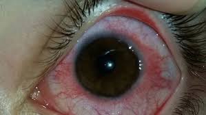 Image result for Vernal Conjunctivitis
