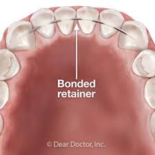 Permanent retainers, while convenient in all the ways shown above, do require some extra work to keep them clean. A Bonded Retainer Might Be A Better Choice After Braces Beautiful Smiles Family Dentistry