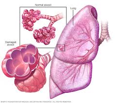 Check spelling or type a new query. Emphysema Symptoms And Causes Mayo Clinic