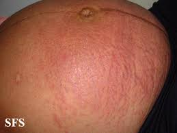 Image result for pruritic urticarial papules and plaques of pregnancy