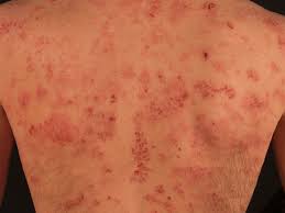 Image result for Eczema nummulare