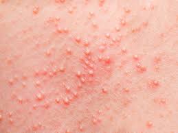 Emuaid.com has been visited by 100k+ users in the past month How To Get Rid Of Sweat Pimples Styles At Life