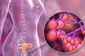 Image result for Candidiasis