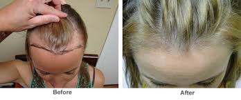 Male pattern hair loss is a condition that is also referred to as androgenic alopecia, or male pattern baldness. What Causes Female Hair Loss At Temples Quora