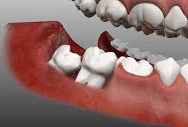 Impacted wisdom teeth cost about $225 to $600 per tooth to remove. Oral Surgery What To Expect Before During And After Wisdom Teeth Removal Directorio Odontologico