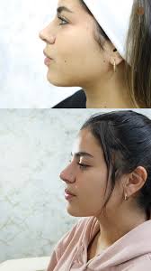 ✨ EL CAMBIO QUE RESALTA TU BELLEZA NATURAL👩🏻‍⚕, Mafer confió en la Dra.  Stephany Gómez para lograr un perfil facial más definido y armonioso 💎, 👉  En la foto de antes vemos su rostro al natural., 👉 En ...