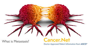 We expect excellent communication for international. What Is Metastasis Cancer Net