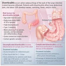 Image result for Diverticulitis