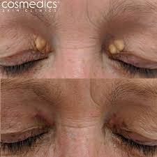 Image result for xantelasma