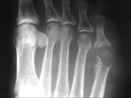Image result for Osteomyelitis XRay
