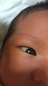 新生児 黄疸 リバウンド 確率