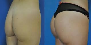 Quel que soit le type de votre intervention, augmentation il existe également des implants fessiers destinés aux hommes. Augmentation Fesses Belgique Prix Implant Fessier Lipofilling Et Sculptra