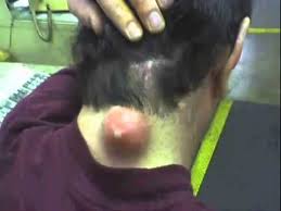 Renso Du Plessis Cricket Live Score Big Pimple Pimples Zits