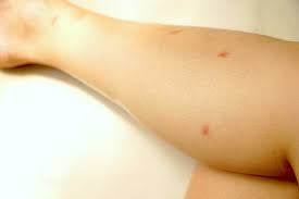 Image result for flea bite