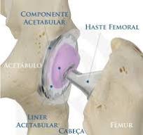 PROTESE DE QUADRIL: Guia Completo sobre a cirurgia de artroplastia de  quadril (2021)
