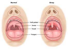 Strep Throat Symptoms And What You Can Do Home Remedies For Strep Strep Throat Home Remedies Home Health Remedies