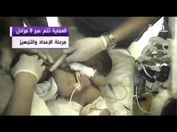 عبدالله ربيعة عملية فصل التوأم السيامي تمت بنجاح Youtube