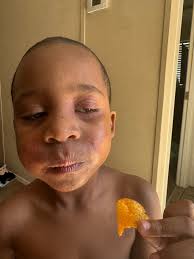 What to do when child has fever and starts aba school?