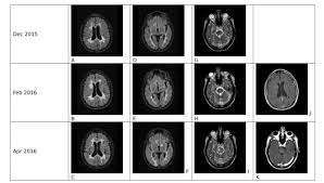 Numbness or weakness in one or more limbs that typically occurs on one side of your body. What Is Causing This Ms Patient S Unusual Symptoms Medpage Today
