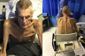 Indonesian old man emaciated thin stock photos. ð™±ðšŽðš— ð™²ðš•ðšŠðš'ðš–ðšŠðš—ðš ð™¹ðš˜ðš'ðš—ð™°ðš„ðš—ðš'ðš˜ðš— On Twitter This Is Awful News Stephen Smith Has Died Stephen Was The Six Stone Emaciated Man Who Dwp Wrongly Deemed Fit To Work And Denied Vital Benefits He Died On