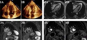 Role of endomyocardial biopsy in the differential 168. A Case Of Myocarditis That Was Not American College Of Cardiology