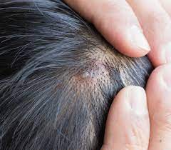 A circle is made around the area about 4mm in diameter. How To Prepare For A Scalp Biopsy Miami Hair Institute