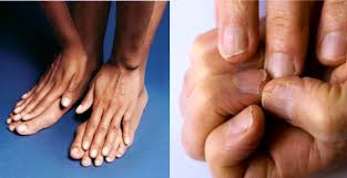 Image result for à¤à¥à¤²à¥à¤¶à¤¿à¤¯à¤® à¤à¥ à¤à¤®à¥
