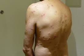 Image result for mite bites on humans